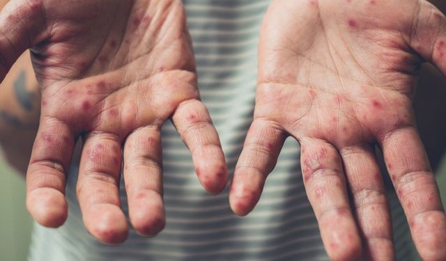 ABD'de kızamık vakaları 33 yılın zirvesinde